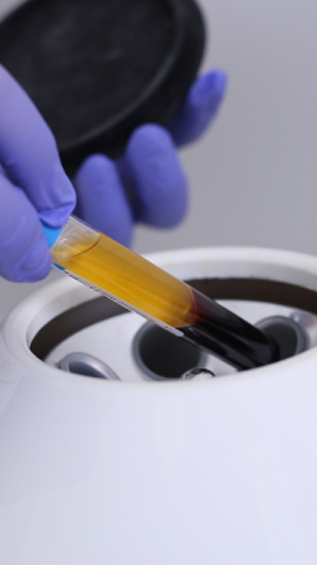 prp-zentrifugiert