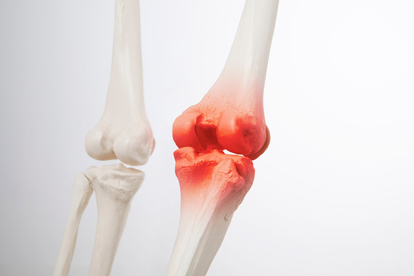 Arthrose-Knie-Vergleich